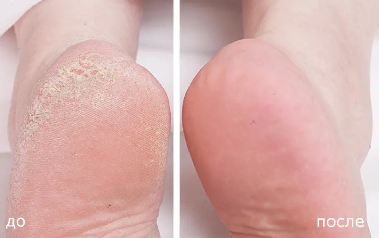 Средство для удаления натоптышей / Callus Eliminator 29 мл BE NATURAL купить по оптовым и розничным ценам